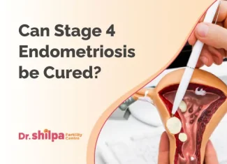 Can Stage 4 Endometriosis Be Cured? Impact and Treatment